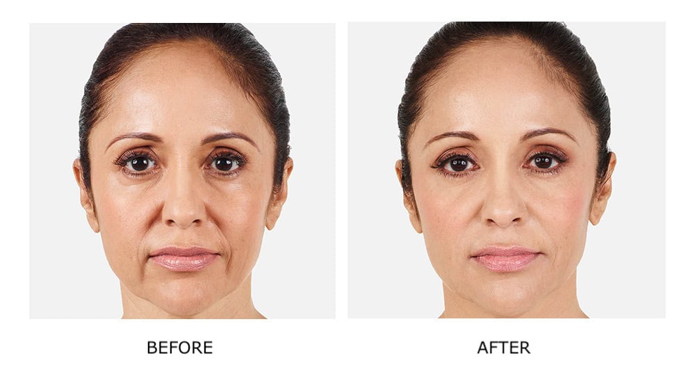 Side-by-side photos of a woman’s face show a “before” image with deeper lines and uneven skin tone, and an “after” image with smoother, brighter skin after treatment with JUVÉDERM dermal fillers.
