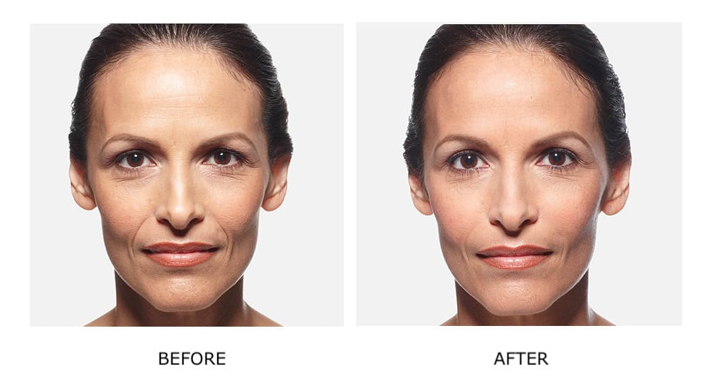 Side-by-side photos of a woman's face labeled "Before" and "After"; the "After" image shows smoother skin with fewer wrinkles, highlighting the rejuvenating effects of dermal fillers.