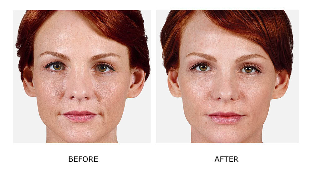 Side-by-side images of a woman’s face showing "before" with visible skin texture and "after" with smoother, more even skin tone after JUVÉDERM cosmetic injectables.