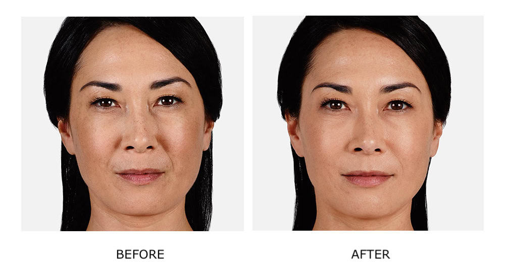 Side-by-side comparison of a woman’s face showing visible improvement in skin tone and texture after JUVÉDERM dermal fillers treatment, labeled "Before" on the left and "After" on the right.