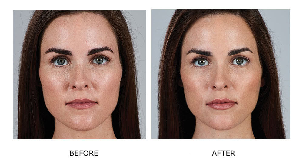 Side-by-side comparison of a woman's face labeled "Before" and "After," showing reduced freckles, smoother skin tone, and brighter complexion in the "After" image following JUVÉDERM dermal fillers.