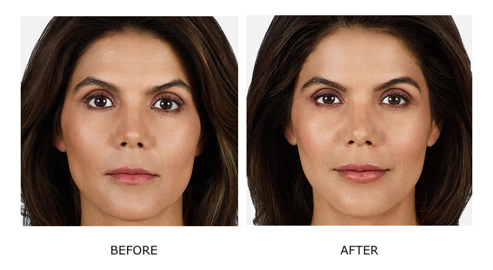 Side-by-side photos of a woman facing forward; the left labeled “Before” shows a neutral expression, while the right labeled “After” highlights subtle makeup enhancement, a slight smile, and refreshed features following cosmetic injectables like JUVÉDERM.