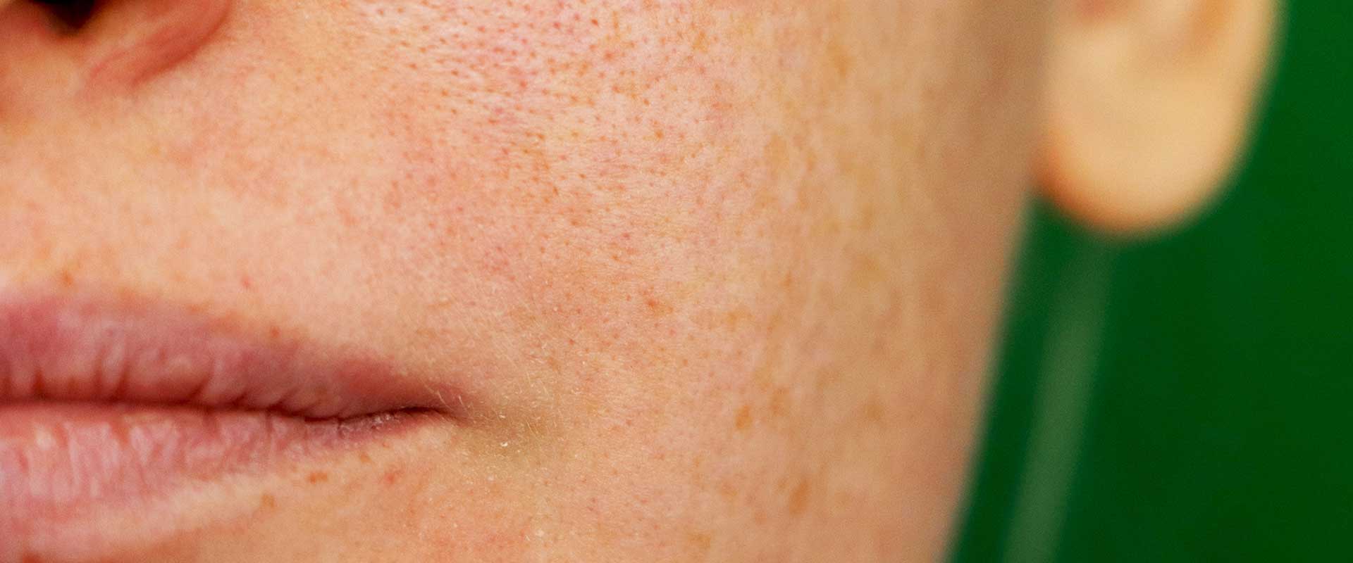 Close-up of a person’s lower face showing lips and freckled skin against a green background.