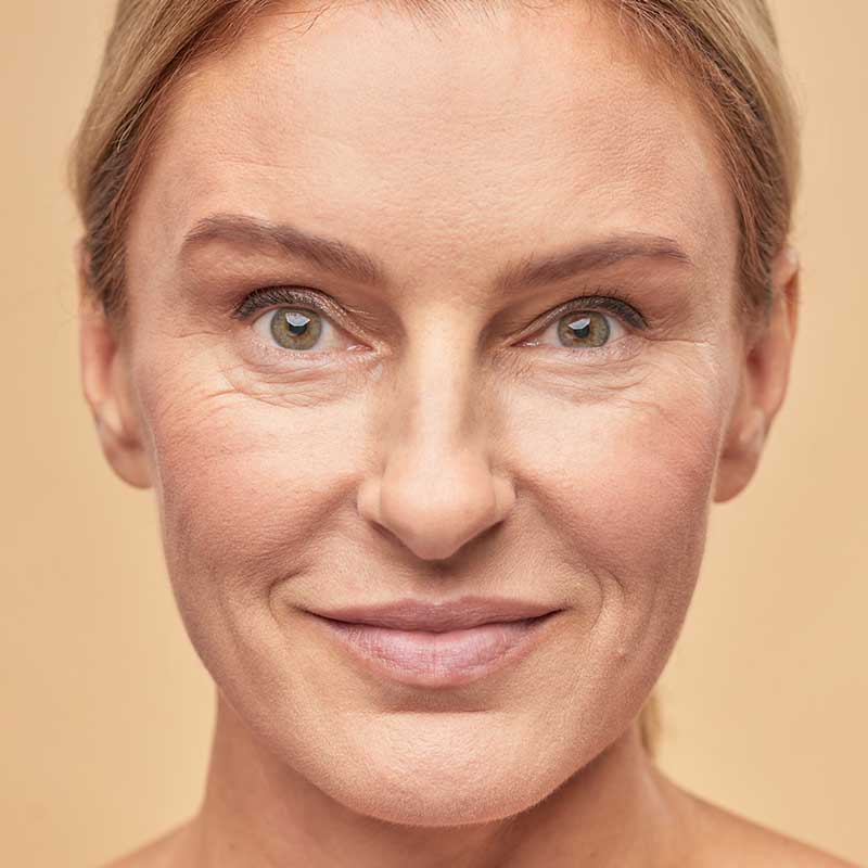 Close-up of a middle-aged woman's face with light skin, minimal makeup, visible fine lines, and signs of facial volume loss, set against a plain beige background.