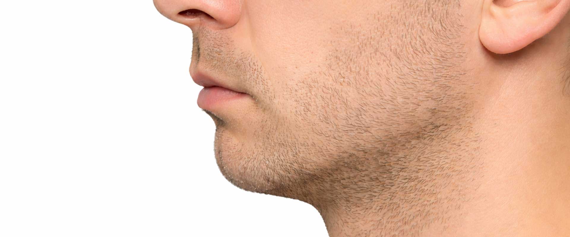 Close-up of the lower face and jawline of a man with light stubble, shown in profile against a white background, highlighting a recessed chin.