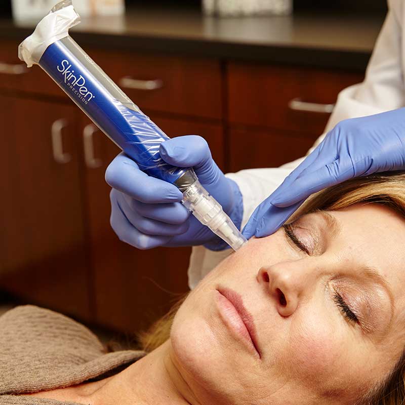 skinpen featured