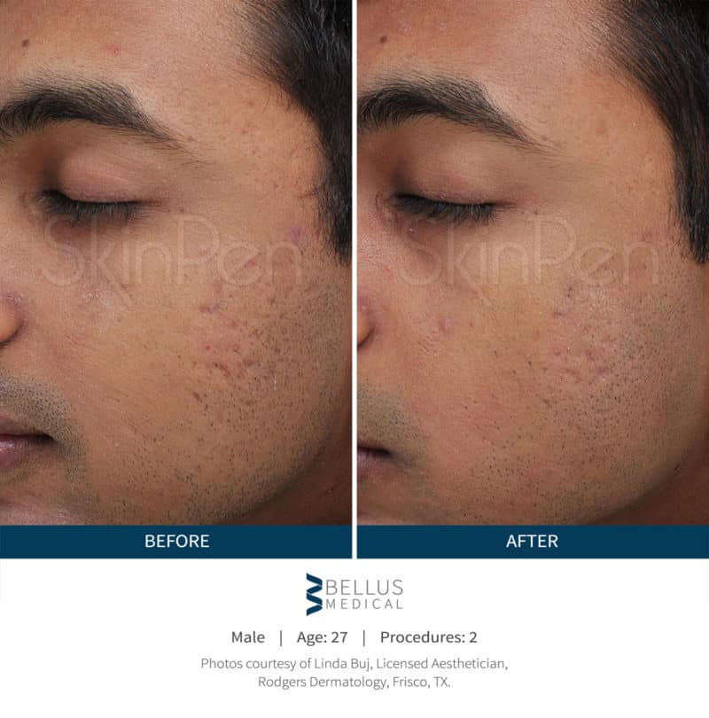 Side-by-side comparison of a man's face before and after SkinPen Microneedling, showing reduced acne scars and smoother skin in the "after" image.