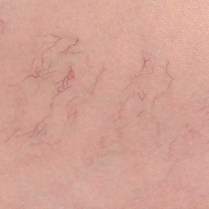 spider veins