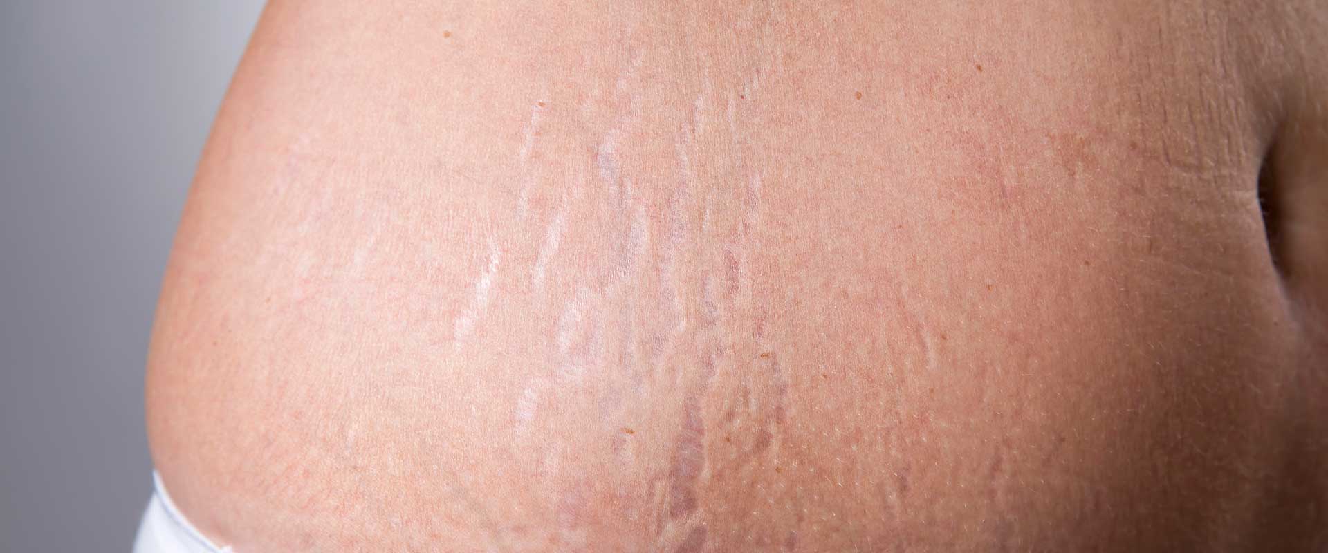 Close-up of skin with visible stretch marks on a person's side or abdomen, ideal for illustrating Stretch Mark Treatment options.