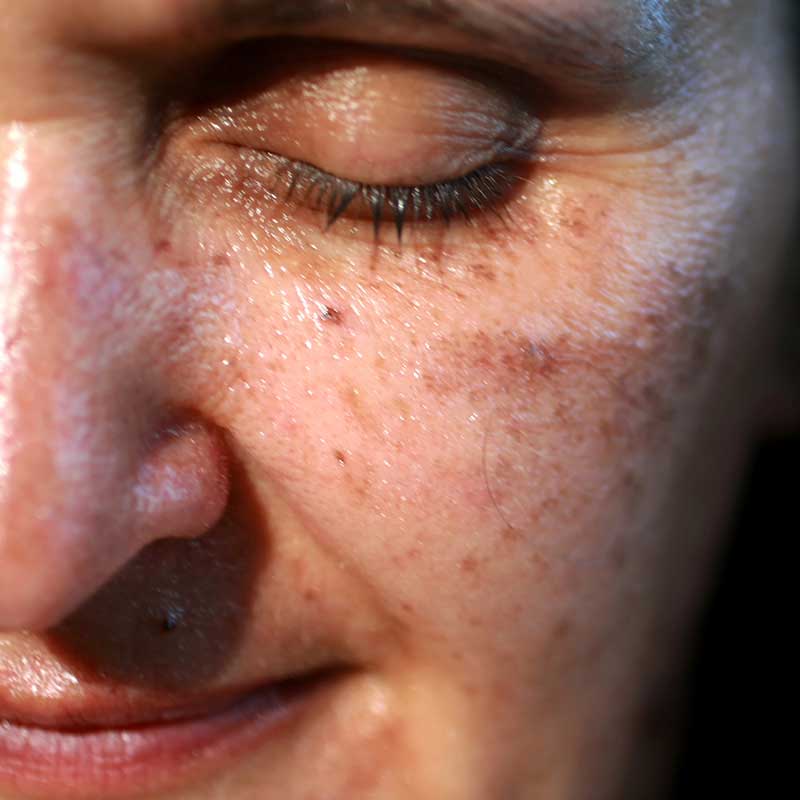 Close-up of a person's face with closed eyes, showing visible pores, freckles, age spots, and textured skin—capturing the effects of sun damage.