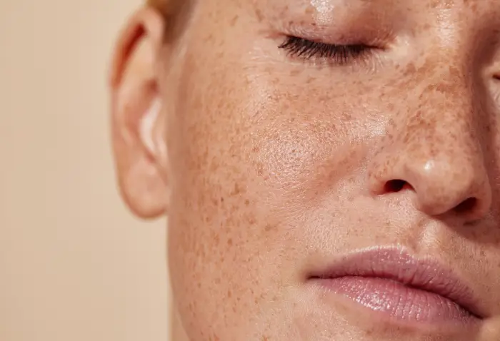 sun damage