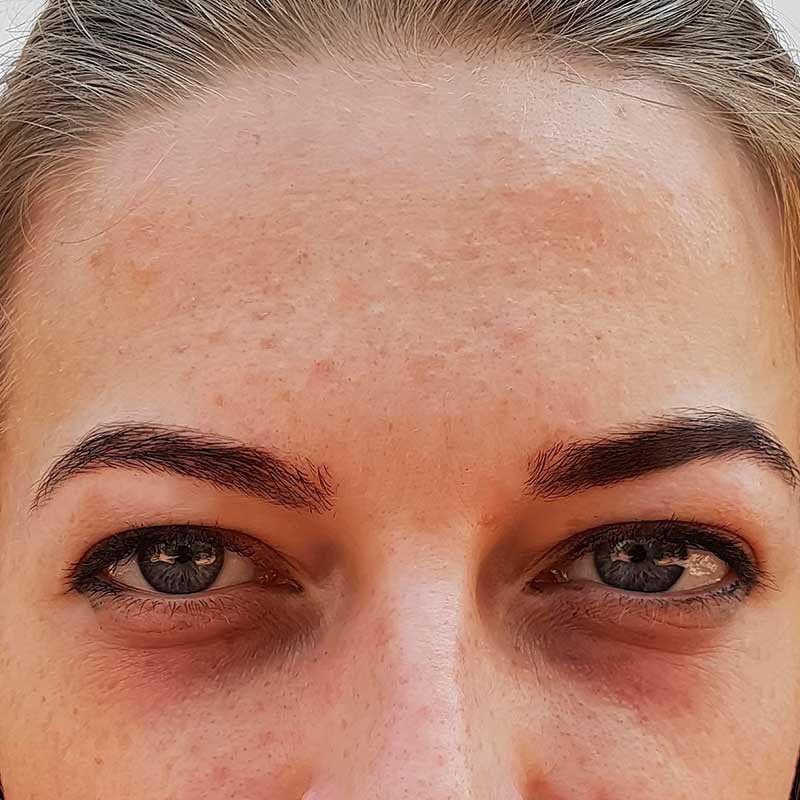 Close-up of a person's forehead and eyes, highlighting visible skin texture and Under Eye Issues such as dark circles.
