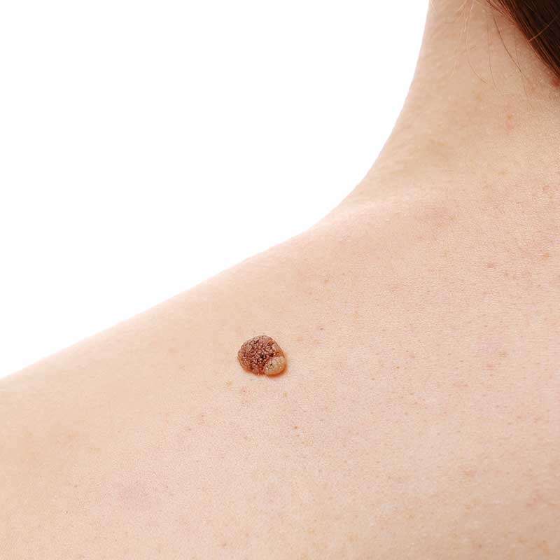 A close-up of a person's upper back showing a raised, brown mole or skin lesion on the skin.